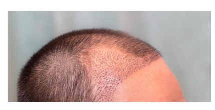 كيف يتم زراعة الشعر ؟1 كيف يتم زراعة الشعر ؟
