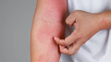 ثقافة عامة ما هي أنواع الحساسية عند الأطفال