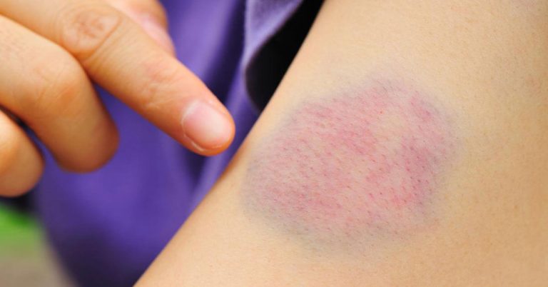 كيف يمكن علاج الكدمات بسرعة