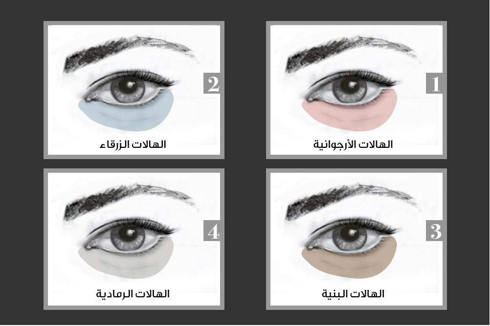 ما هي أنواع الهالات السوداء ؟ أنواع الهالات السوداء
