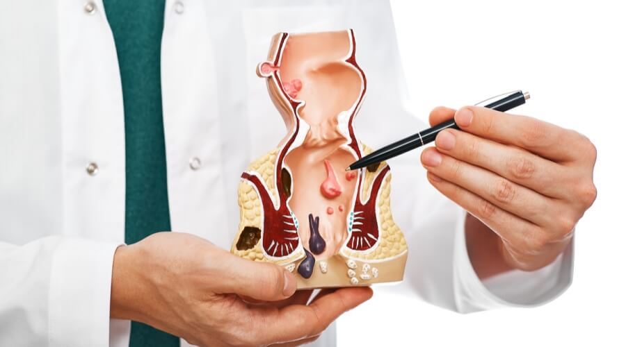 كيف يمكن العيش مع البواسير ؟ كيف يمكن العيش مع البواسير ؟ marocdoc
