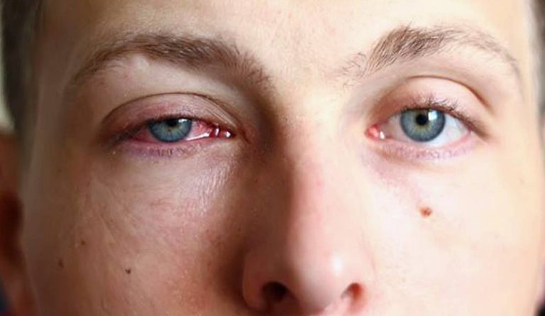 أسباب التهاب العين