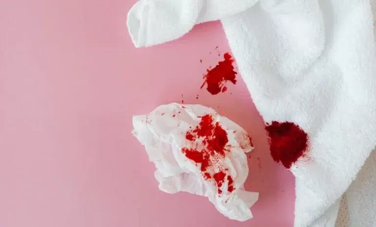 خروج الدم مع البراز بسبب البواسير