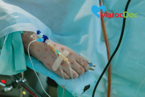 كشف أسرار جدري القرود Monkeypox: فهم الفيروس وإدارته في عالمنا الحديث 2024 التوصيات الصحية العالمية: إرشادات من منظمة الصحة العالمية بشأن جدري القرود