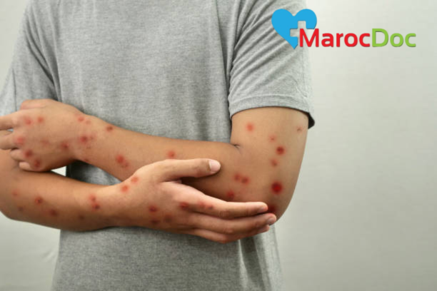 كشف أسرار جدري القرود Monkeypox: فهم الفيروس وإدارته في عالمنا الحديث 2024 أعراض جدري القرود: كيف تميز بينه وبين الأمراض الأخرى؟