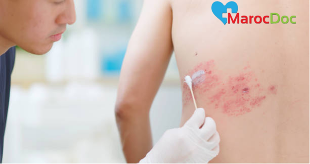 أسرع طريقة لعلاج الحزام الناري 2024 أسرع طريقة لعلاج الحزام الناري: العلاجات المنزلية والتدابير الوقائية