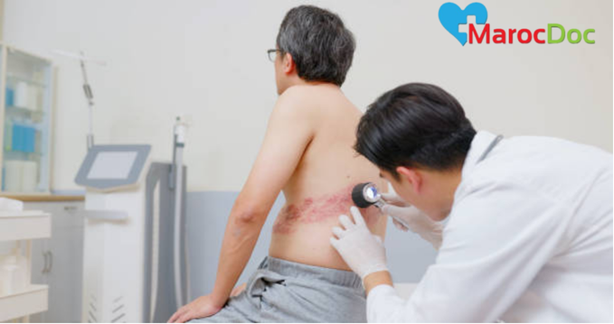 أسرع طريقة لعلاج الحزام الناري 2024 أسرع طريقة لعلاج الحزام الناري: العلاجات الطبية الفعالة