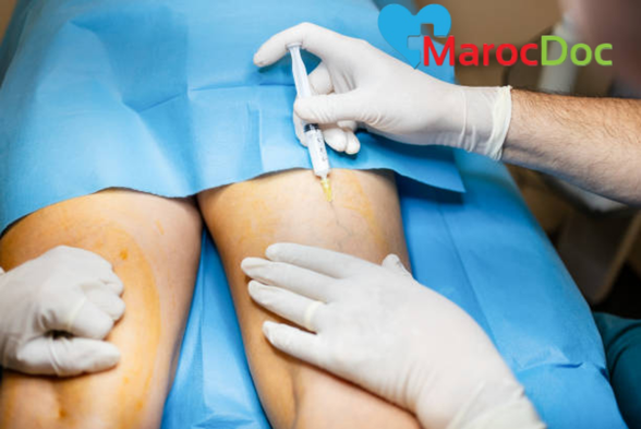 5 طرق مختلفة لعلاج الدوالي عند النساء فعالية الحقن الموضعي في علاج الدوالي عند النساء