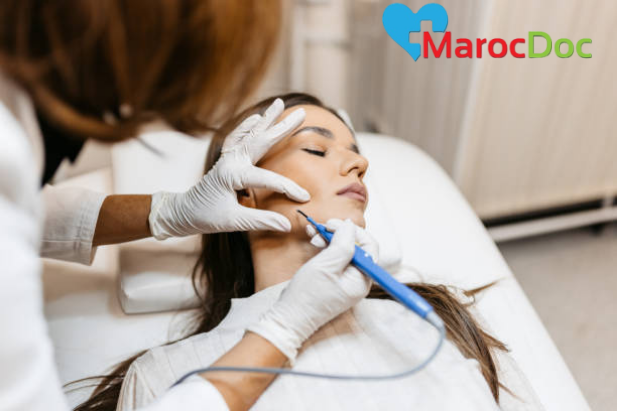 طرق علاج الرؤوس السوداء