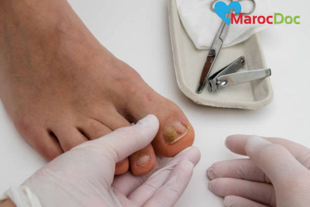 استشارة الأطباء لعلاج مسمار القدم