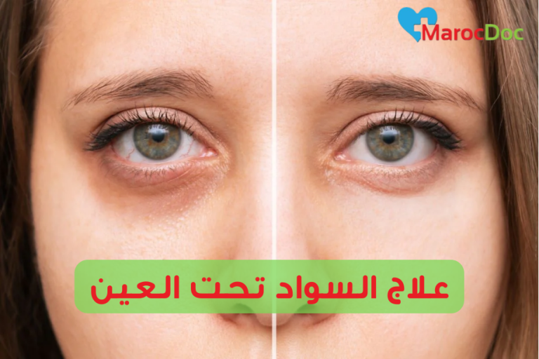 علاج السواد تحت العين