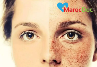 4 تقنيات ليزر حديثة لعلاج النمش في الوجه دور التقشير الكيميائي في علاج النمش في الوجه
