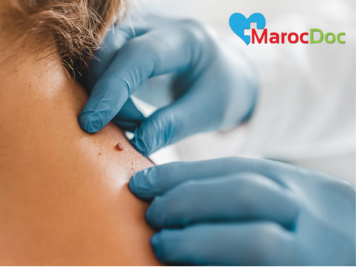 7 خيارات جراحية وغير جراحية لعلاج الزوائد الجلدية أسباب ظهور الزوائد الجلدية على الجلد