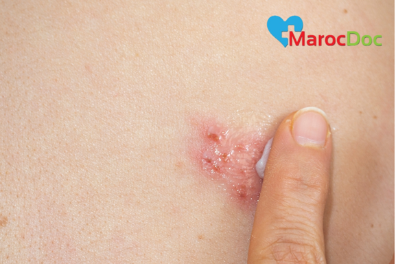 5 أسباب حول ظهور حبوب دهنية على الثدي العلاج الطبي لحبوب دهنية على الثدي