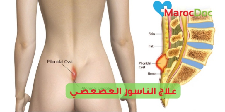 علاج الناسور العصعصي