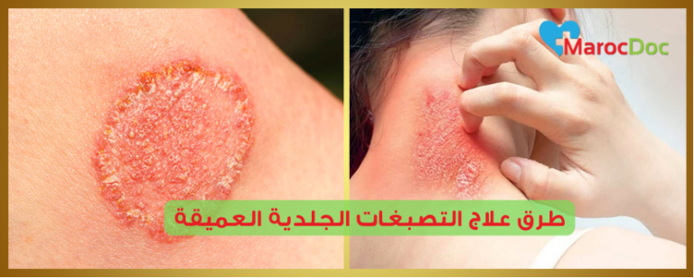 الحل النهائي لفطريات الجلد