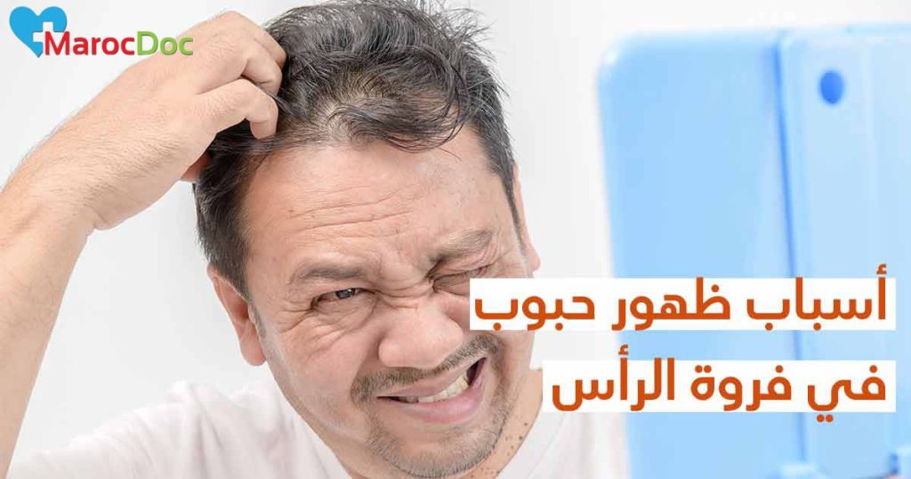 حبوب فروة الرأس: الأسباب، الأنواع، وطريقة العلاج الشامل 1 حبوب-فروة-الرأس-كل-ما-تحتاج-معرفتة-عن-الأسباب-والحلول