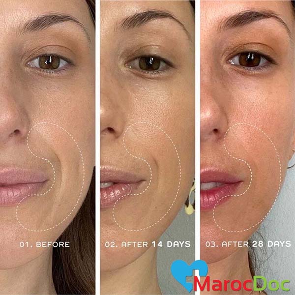 Ren_Bio_Retinoid_Youth_Serum_30ml_BeforeAfter_الريتينول المكوّن السحري لصحة البشرة وجمالها