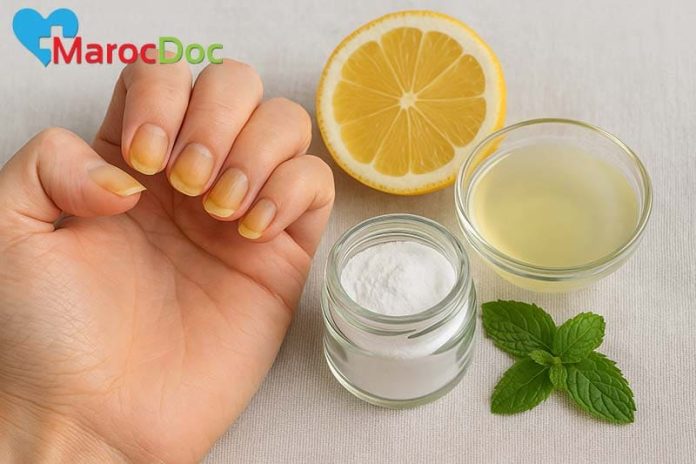أسباب اصفرار الأظافر وطرق العلاج الطبيعية في المنزل