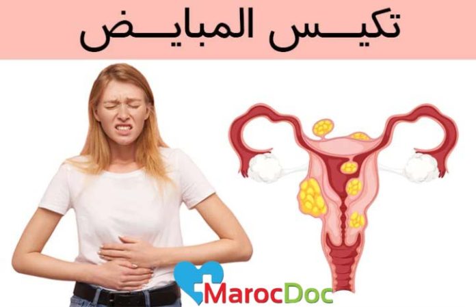 تكيس المبايض PCOS يسبب حب الشباب زيادة الوزن تساقط الشعر