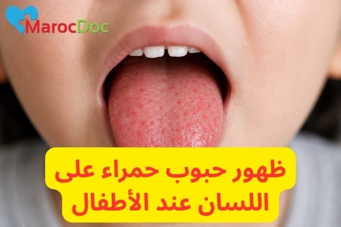 أسباب ظهور حبوب حمراء على اللسان عند الأطفال وطرق العلاج marocdoc